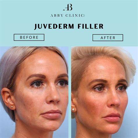 Fillers