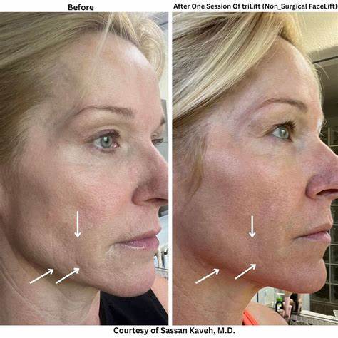 Facelift